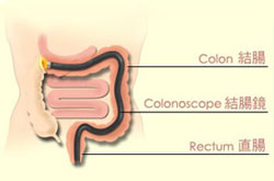 Colonoscopy