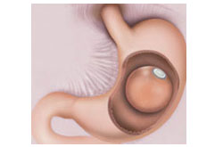 Intragastric Balloon
