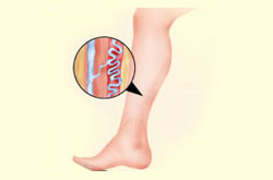 Varicose Veins